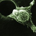 An invasive cancer cell moves with its leading edge