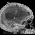 Brain Pacemaker