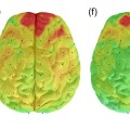 Brain hyperactivity