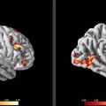 Brain scans could help doctors find treatments for people with social anxiety disorder
