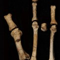 Burtele partial foot
