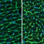 Cancer Drug Treats Rare Cardiac Disease