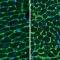 Cancer Drug Treats Rare Cardiac Disease