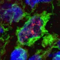 Dendritic cell in a tuberculoid leprosy lesion