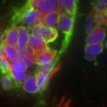 Discovery Reveals Important Clues to Cancer Metastasis