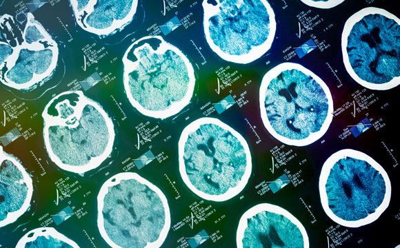 Engineers Are Building Computer Systems to Predict Alzheimer’s and Changes in the Brain