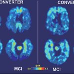 From mild cognitive impairment to Alzeimer's disease