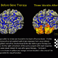 Gene therapy for congenital blindness has taken another step forward