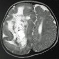 Hemimegalencephaly