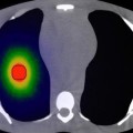 High-Energy Electrons to Treat Cancer