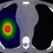 High-Energy Electrons to Treat Cancer