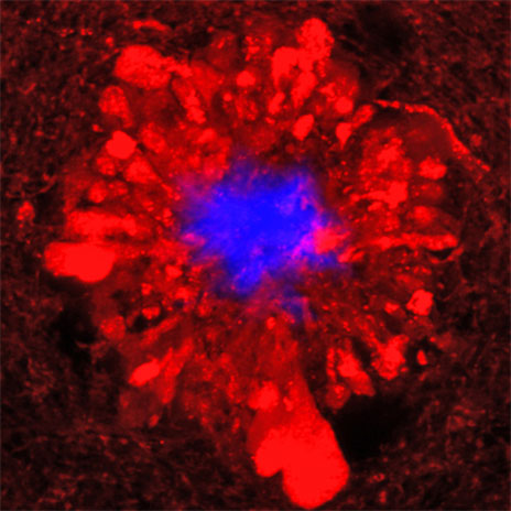 New Research Shows Hyperactive Neurons May Trigger Alzheimer’s
