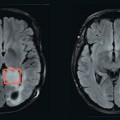 MR Spectroscopy Helps Measure Brain Tumor Mutation