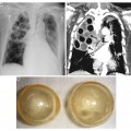 MRSA-pneumonia-deaths