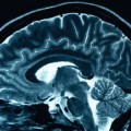 Size Does Matter When Determining Alzheimer's Risk