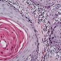 Squamous cell lung cancer