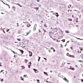 alzheimer-plaque-amyloid-onset