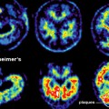 brain-with-alzheimer-without