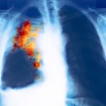 color-x-ray-lung-cancer