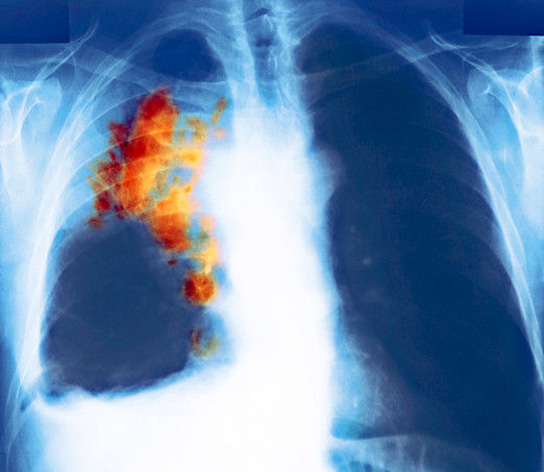 color-x-ray-lung-cancer