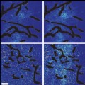 combining angiogenesis inhibitors and nanomedicines improves cancer treatment