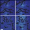 combining angiogenesis inhibitors and nanomedicines improves cancer treatment