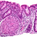 comprehensive look at chemical and genetic changes that occur as inflammation progresses to cancer