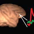 consciousness is not localised in a unique cortical area