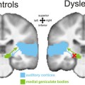discovered an important neural mechanism underlying dyslexia
