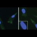 fibroblasts from an unaffected individual (left) and an ALS patient with a FUS mutation