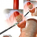 gastric-bypass-surgery
