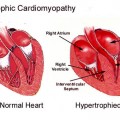 hypertrophic-cardiomyopathy