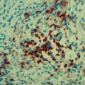 infiltrate-induced-cell