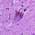 lewy-body-neuron