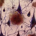 loss of connections between neuron cells