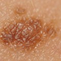 melanoma