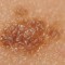 melanoma