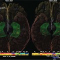memory in adults impacted by versions of four genes