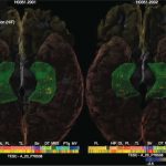 memory in adults impacted by versions of four genes
