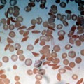 microfluidic device that can analyze the behavior of blood samples from sickle cell disease patients
