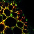 microscope image shows many enlarged lysosomes inside a mouse skin cell