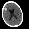 monitoring strategy helps doctors treat patients with head injuries