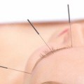 placebo-acupuncture