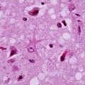 prion-disease