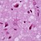 prion-disease