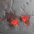 protein phosphatase SHP2 promotes breast cancer with poor prognosis