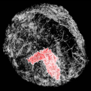 technique images breast tumors in 3-D