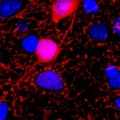underlying cause of the seizures that affect 90 percent of people with Angelman syndrome