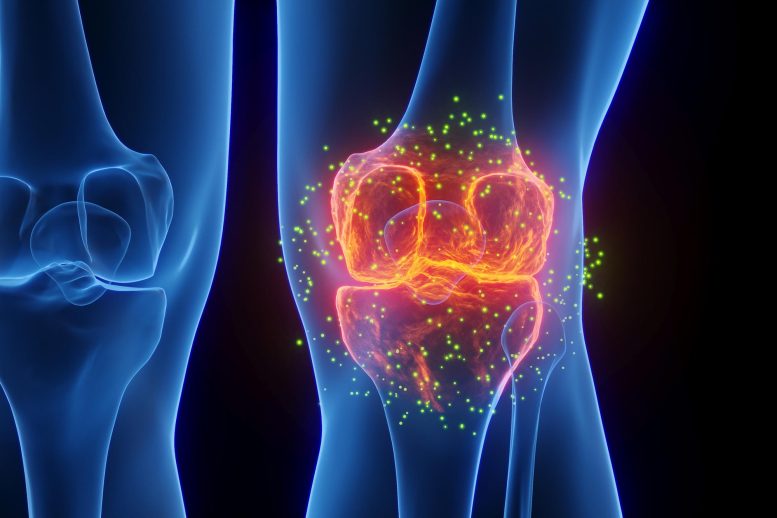 3D Knee Arthritis Joint Inflammation