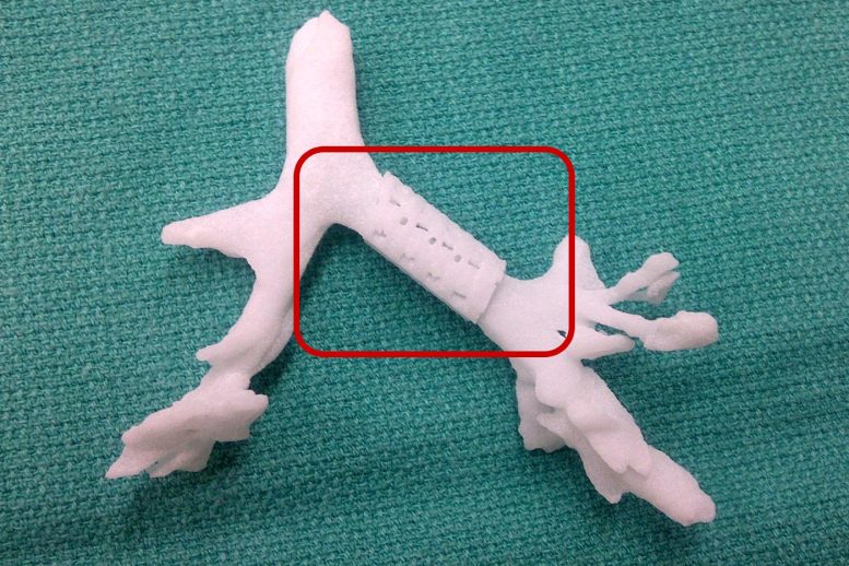 3D Printed Airway Splint